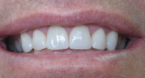 Smile Makeover - After